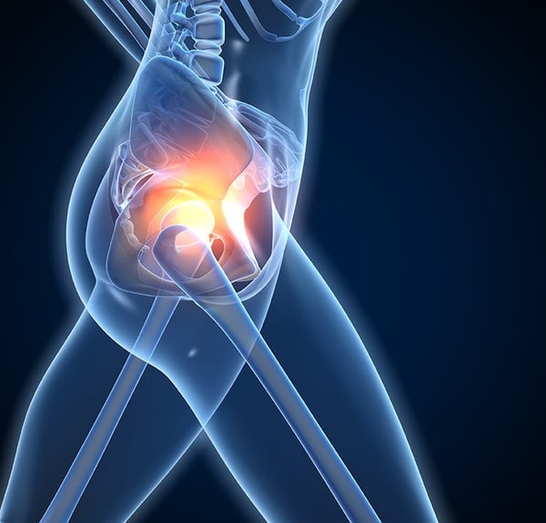 Orion Hip Arthritis